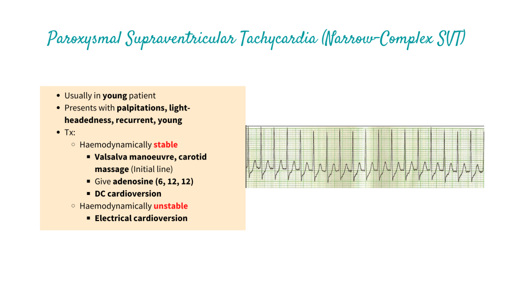 Paroxysmal Supraventricular Tachycardia (Narrow-Complex SVT)