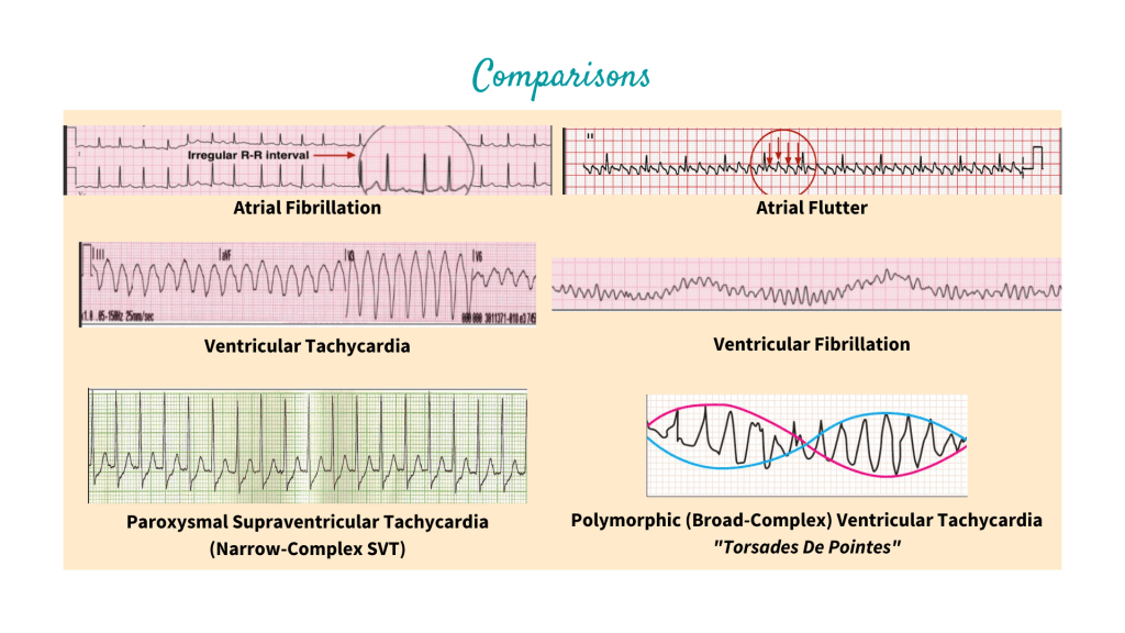 Comparison between atrial fibrillation, atrial flutter, ventricular tachycardia, ventricular fibrillation, paroxysmal supraventricular tachycardia (Narrow-complex SVT) and polymorphic (broad-complex) ventricular tachycardia "torsades de pointes"