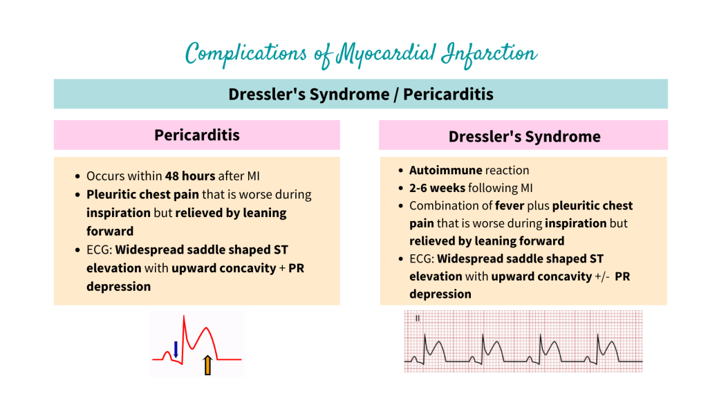 Complications of Myocardial Infarction - Dressler's Syndrome, Pericarditis