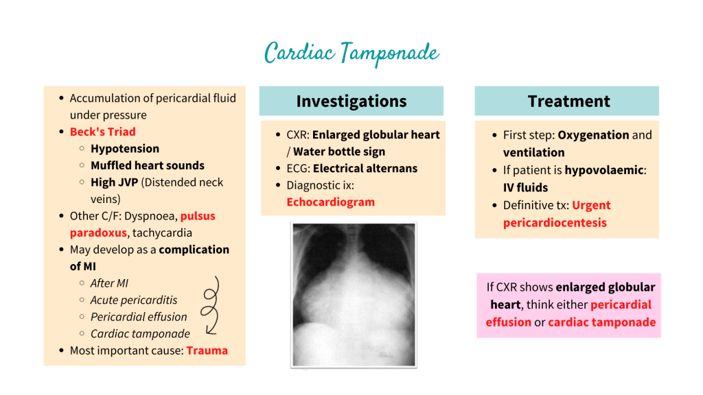 Cardiac Tamponade - Beck's Triad, Investigations and Treatment
