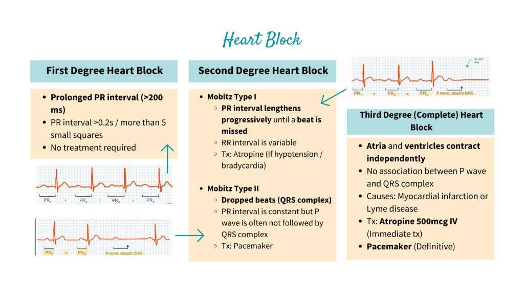 First degree, second degree and third degree (complete) heart block