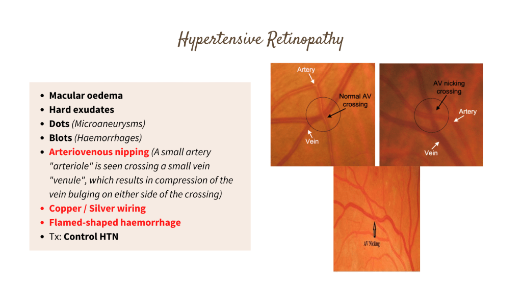 Hypertensive Retinopathy
