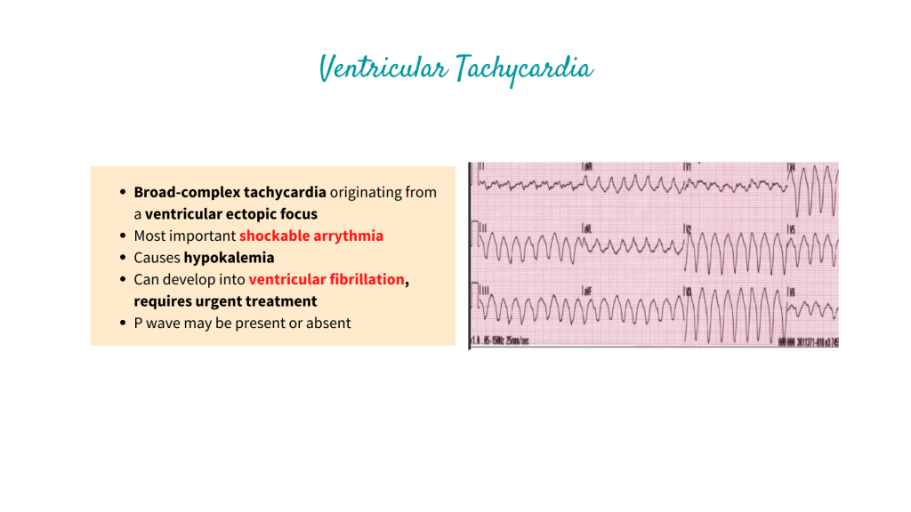 Ventricular Tachycardia