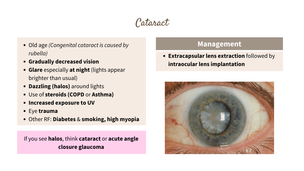 Cataract disease in the eye, ophthalmology