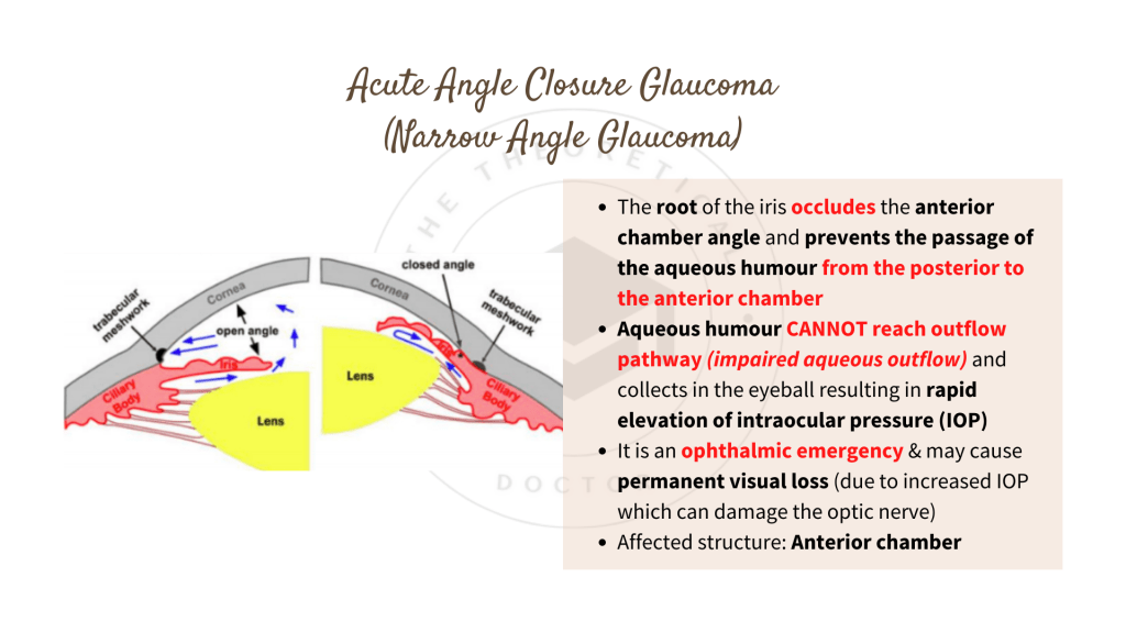 Acute Angle Closure Glaucoma (Narrow Angle Glaucoma)