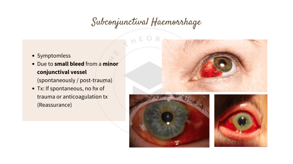 Subconjunctival Haemorrhage
