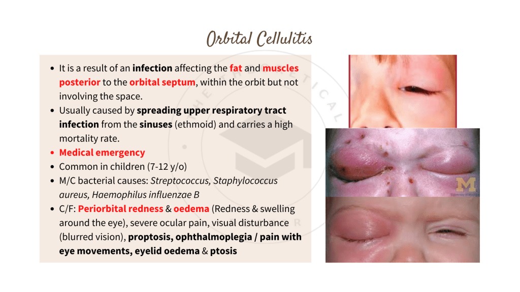 Orbital Cellulitis