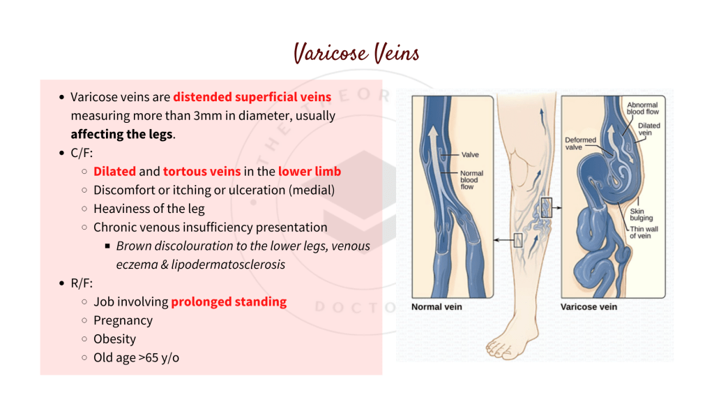 Presentation, signs and symptoms of varicose veins