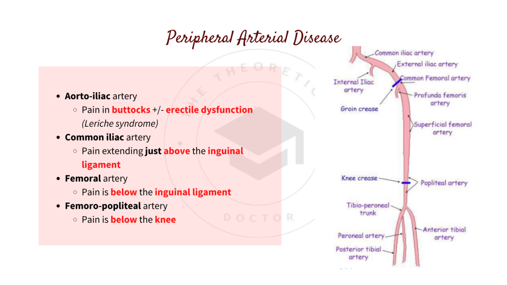 Site of occlusion in peripheral arterial disease (PAD)