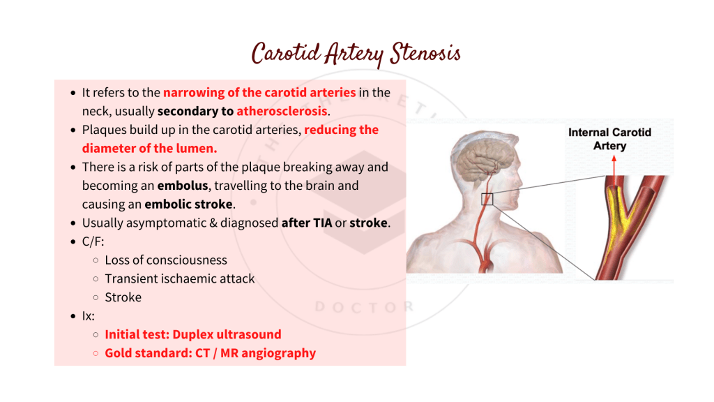 Presentation, signs and symptoms of carotid artery stenosis. What is carotid artery stenosis?